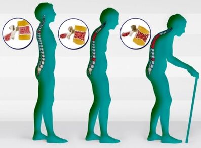 Osteoporoze